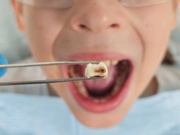 Best Emergency Tooth Extraction in Trophy Clu, TX